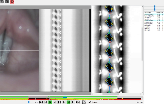 Automatic Evaluation of Videokymographic Records for Early Diagnosis and Prevention of Vocal Cord Cancer